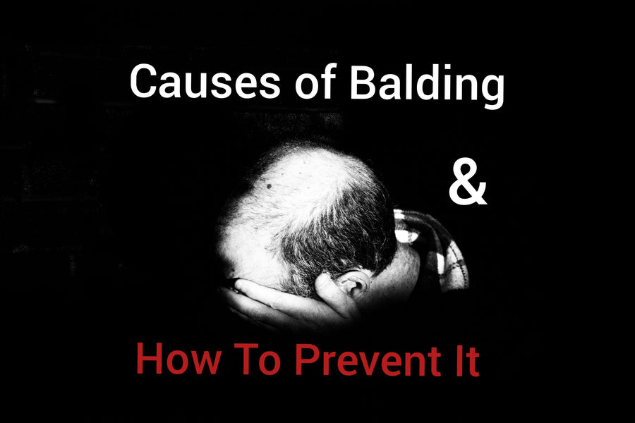 Causes of Balding & How To Prevent It